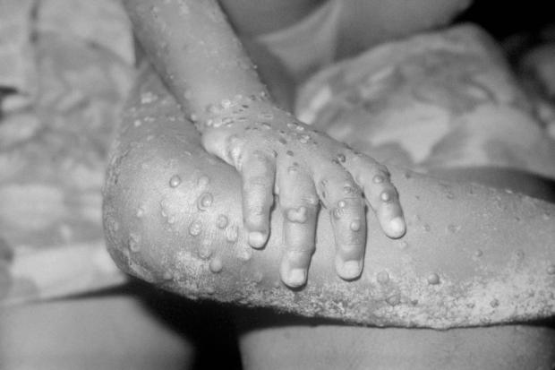 Redditch Advertiser: The monkeypox virus can be spread in a number of ways. Picture: PA